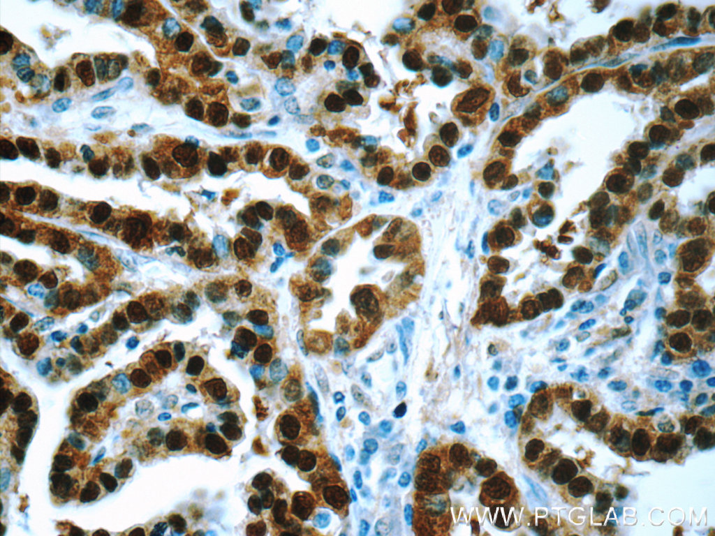 IHC staining of human thyroid cancer using 14987-1-AP