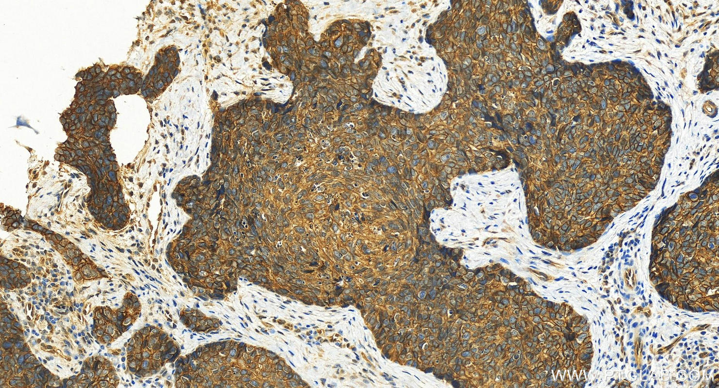 IHC staining of human bowen disease using 11456-1-AP