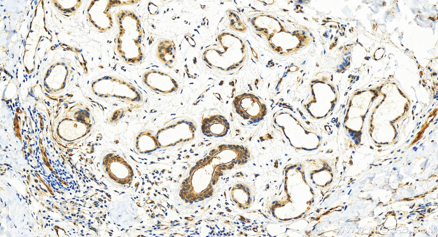 IHC staining of human bowen disease using 11456-1-AP