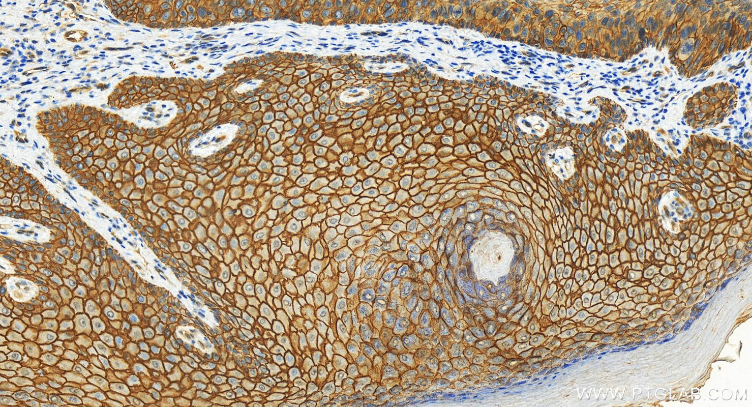 IHC staining of human bowen disease using 11456-1-AP