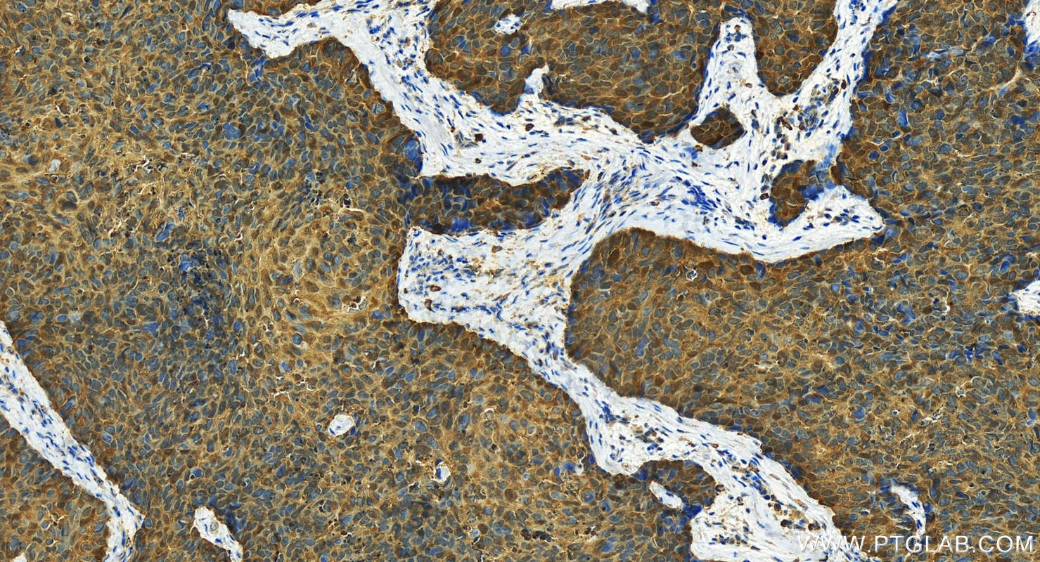 IHC staining of human bowen disease using 15454-1-AP