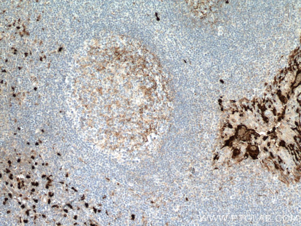 IHC staining of human tonsillitis using 66853-1-Ig (same clone as 66853-1-PBS)