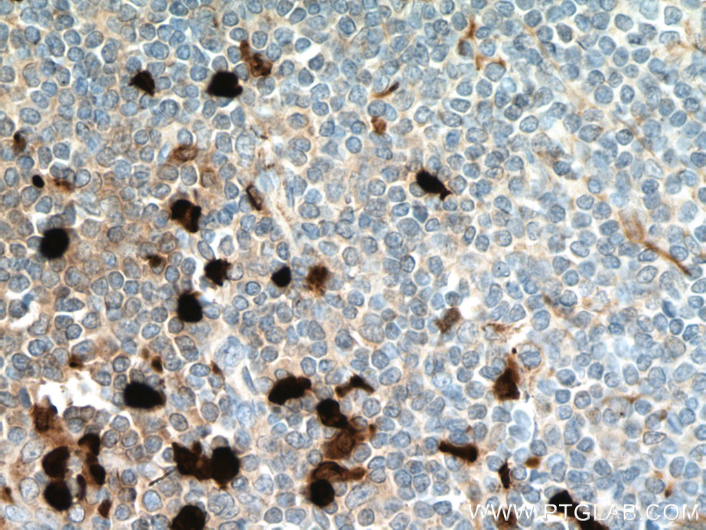 IHC staining of human tonsillitis using 66853-1-Ig (same clone as 66853-1-PBS)