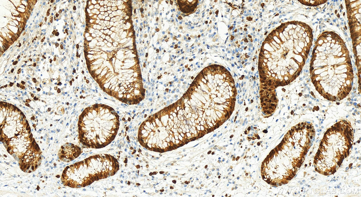 IHC staining of human colon cancer using 11803-1-AP