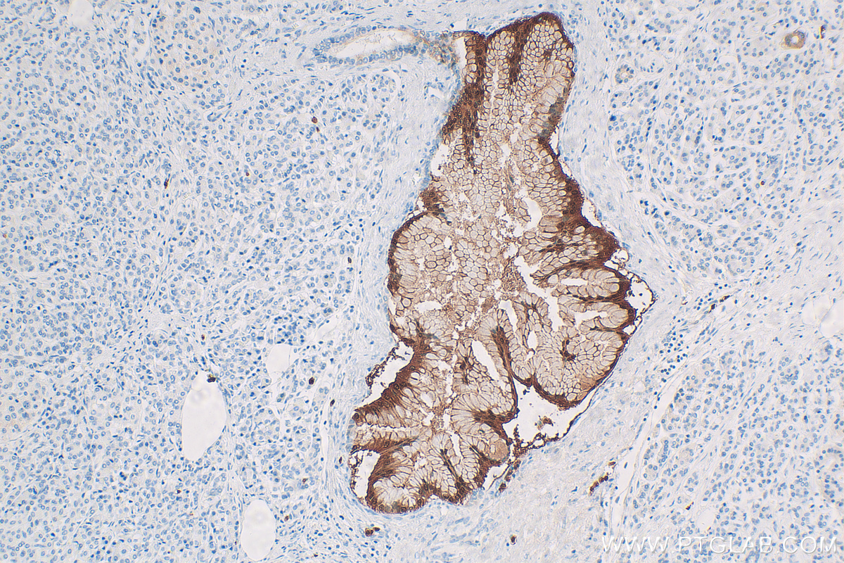 IHC staining of human pancreas cancer using 11803-1-AP