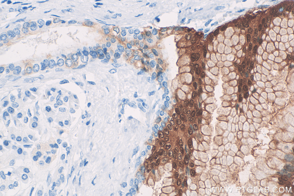 IHC staining of human pancreas cancer using 11803-1-AP