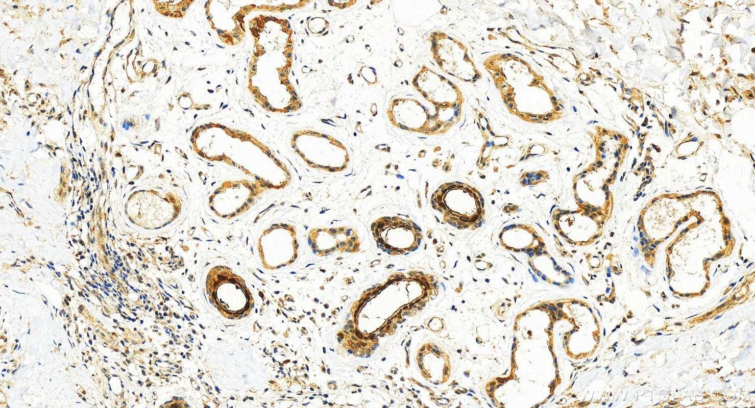 IHC staining of human bowen disease using 11803-1-AP