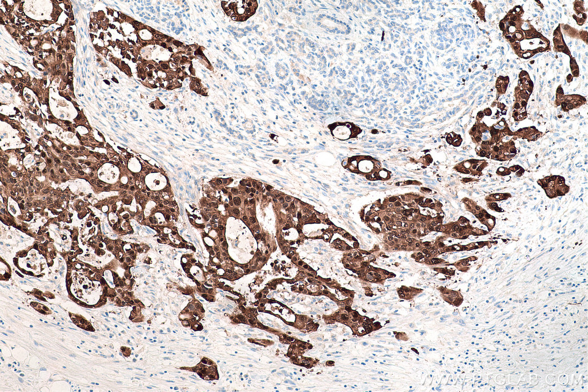 IHC staining of human pancreas cancer using 67485-1-Ig (same clone as 67485-1-PBS)