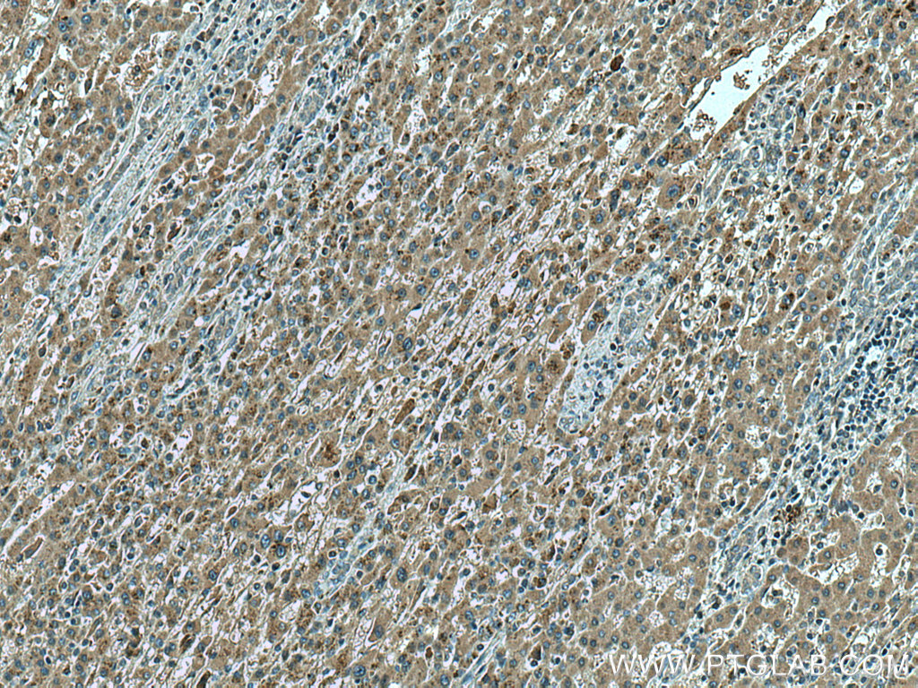 IHC staining of human liver cancer using 67425-1-Ig (same clone as 67425-1-PBS)