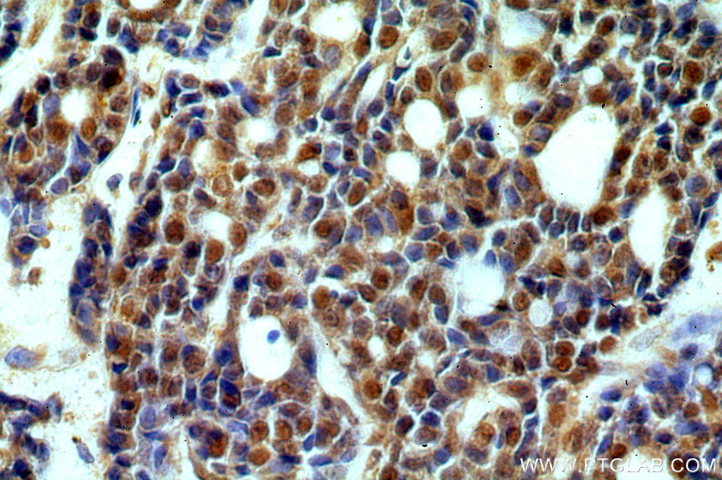 IHC staining of human cervical cancer using 13841-1-AP