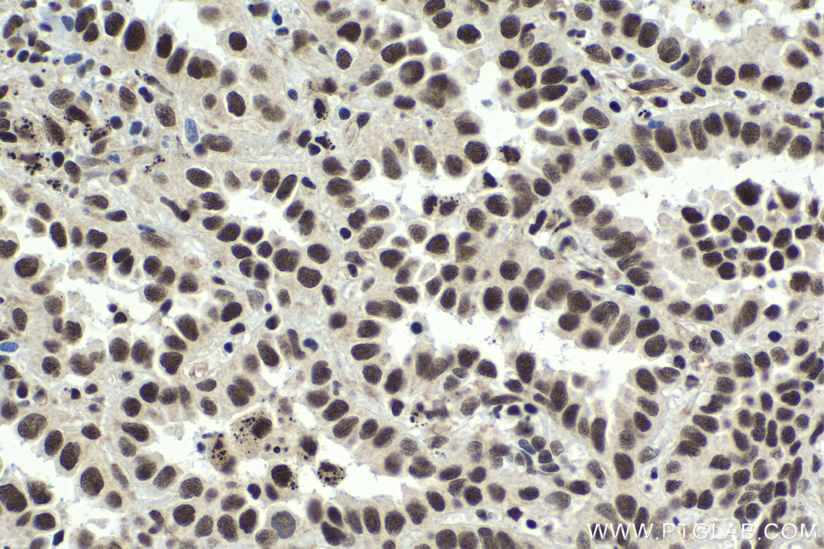 IHC staining of human lung cancer using 18025-1-AP