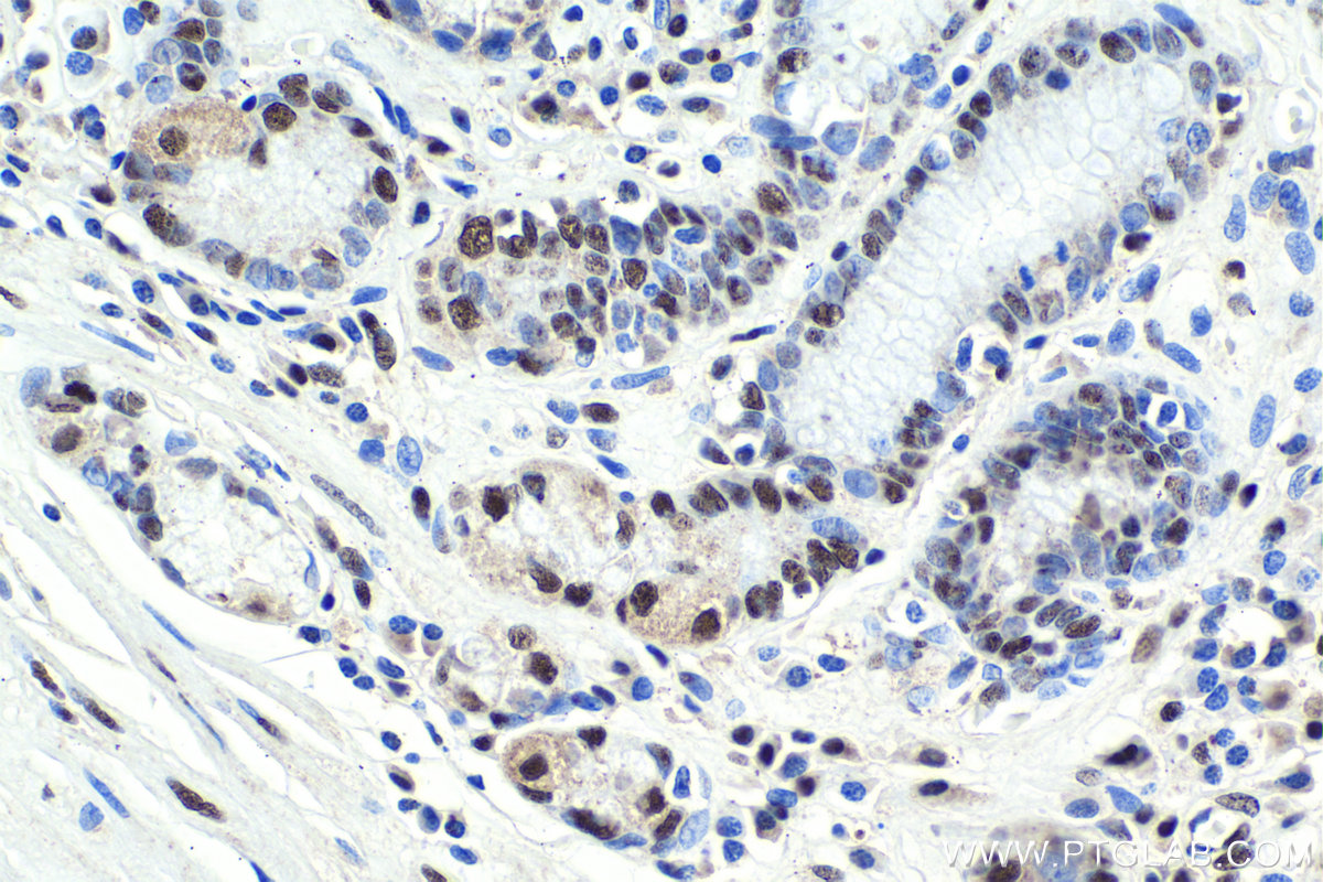 IHC staining of human stomach cancer using 18025-1-AP