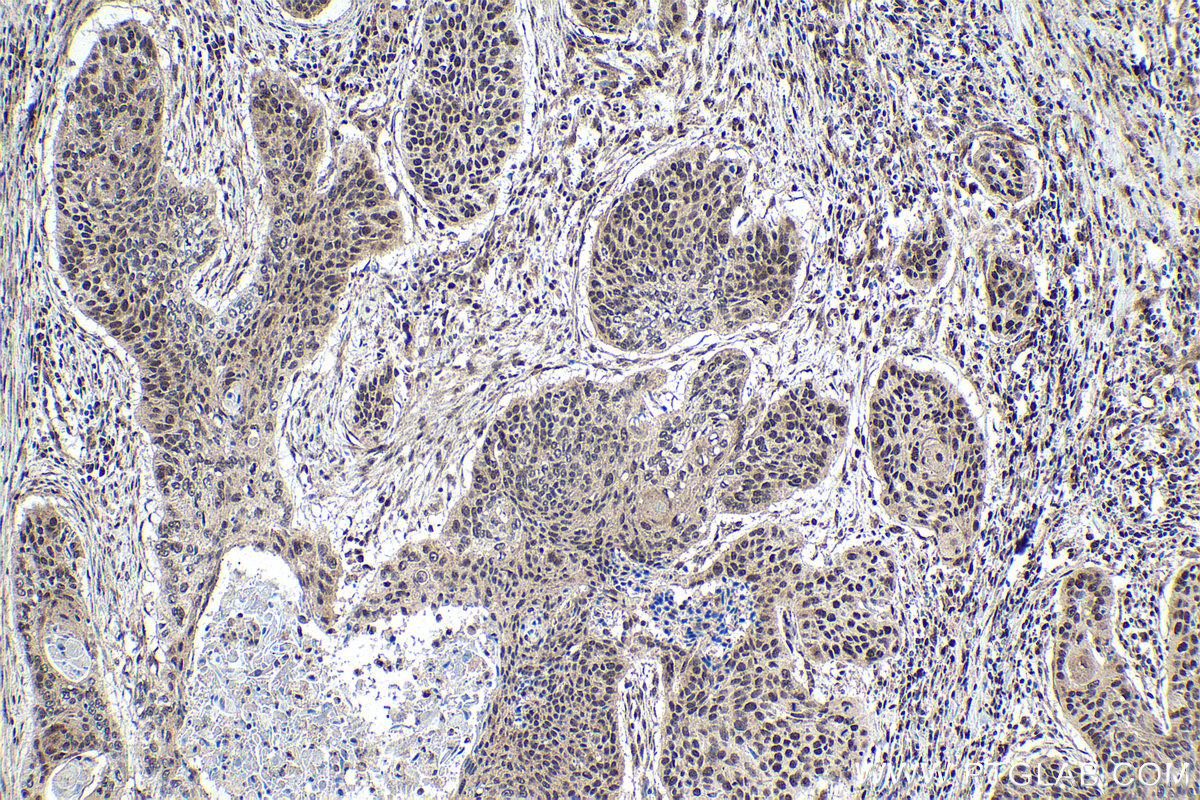 IHC staining of human oesophagus cancer using 15400-1-AP