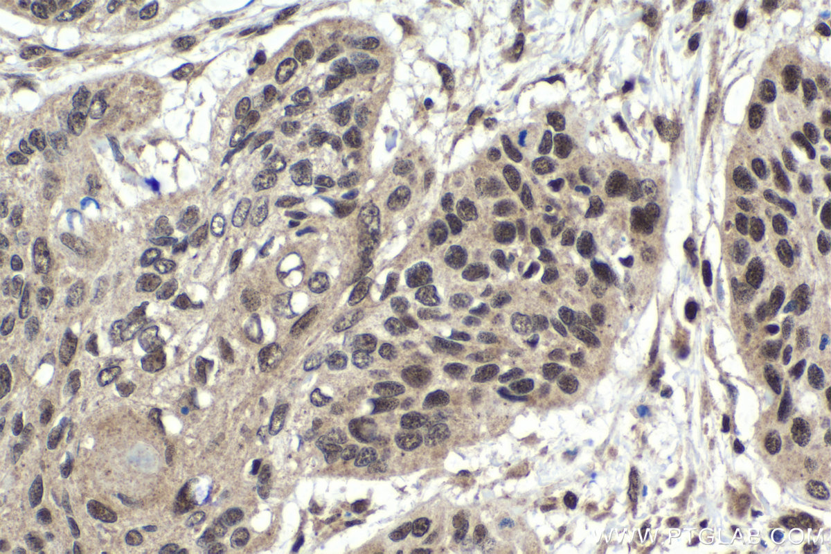 IHC staining of human oesophagus cancer using 15400-1-AP