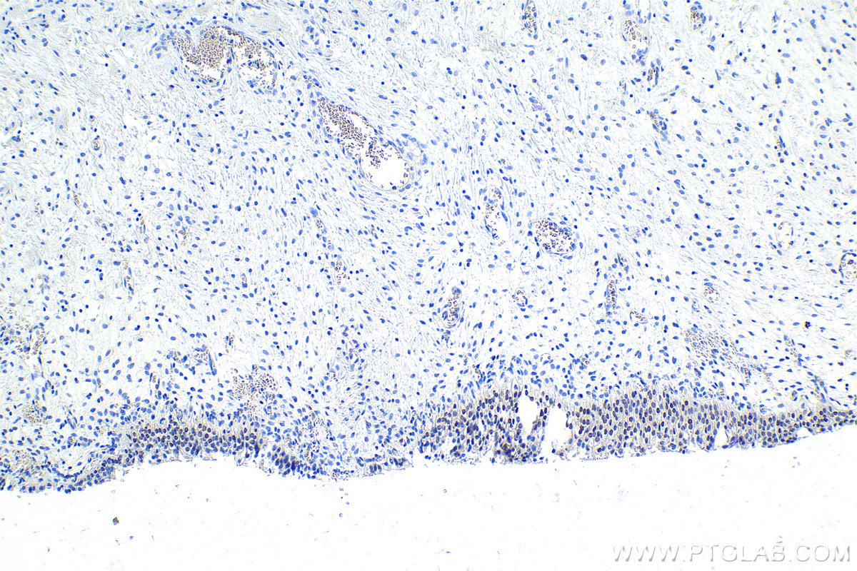 IHC staining of human urothelial carcinoma using 15400-1-AP