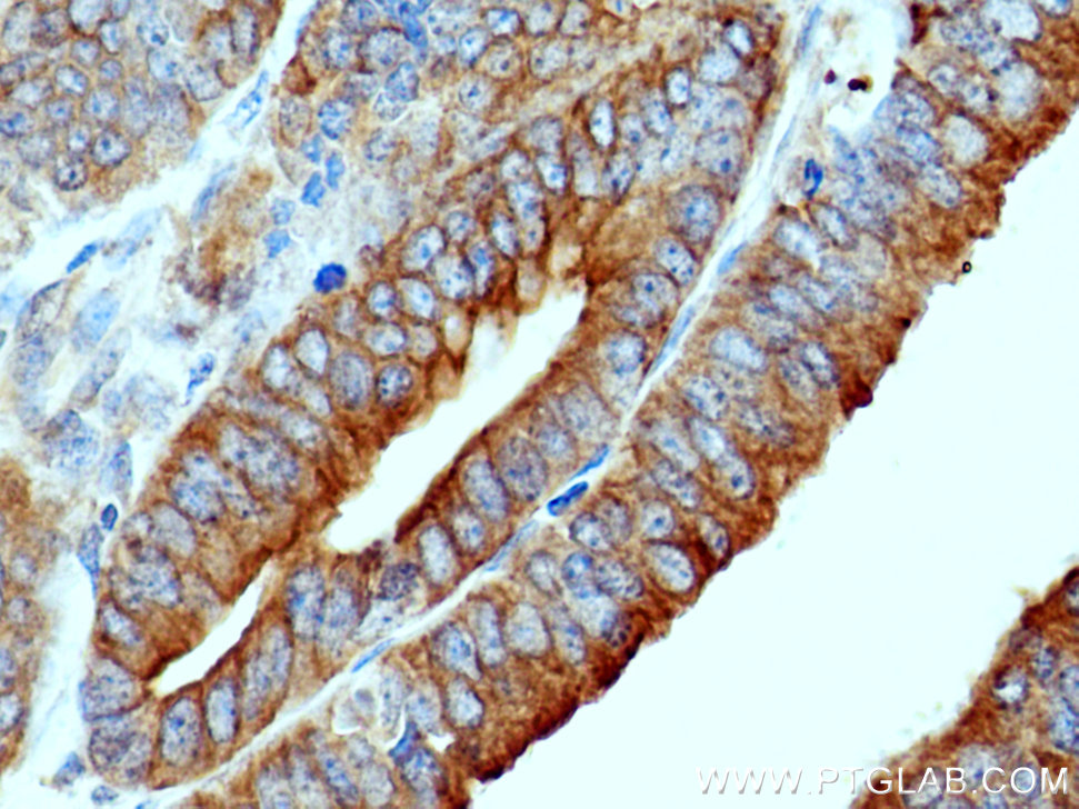 IHC staining of human endometrial cancer using 12569-1-AP