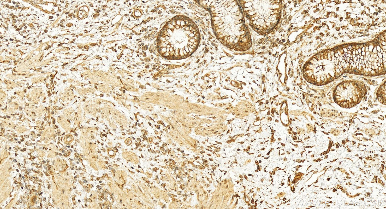 IHC staining of human colon cancer using 13375-1-AP