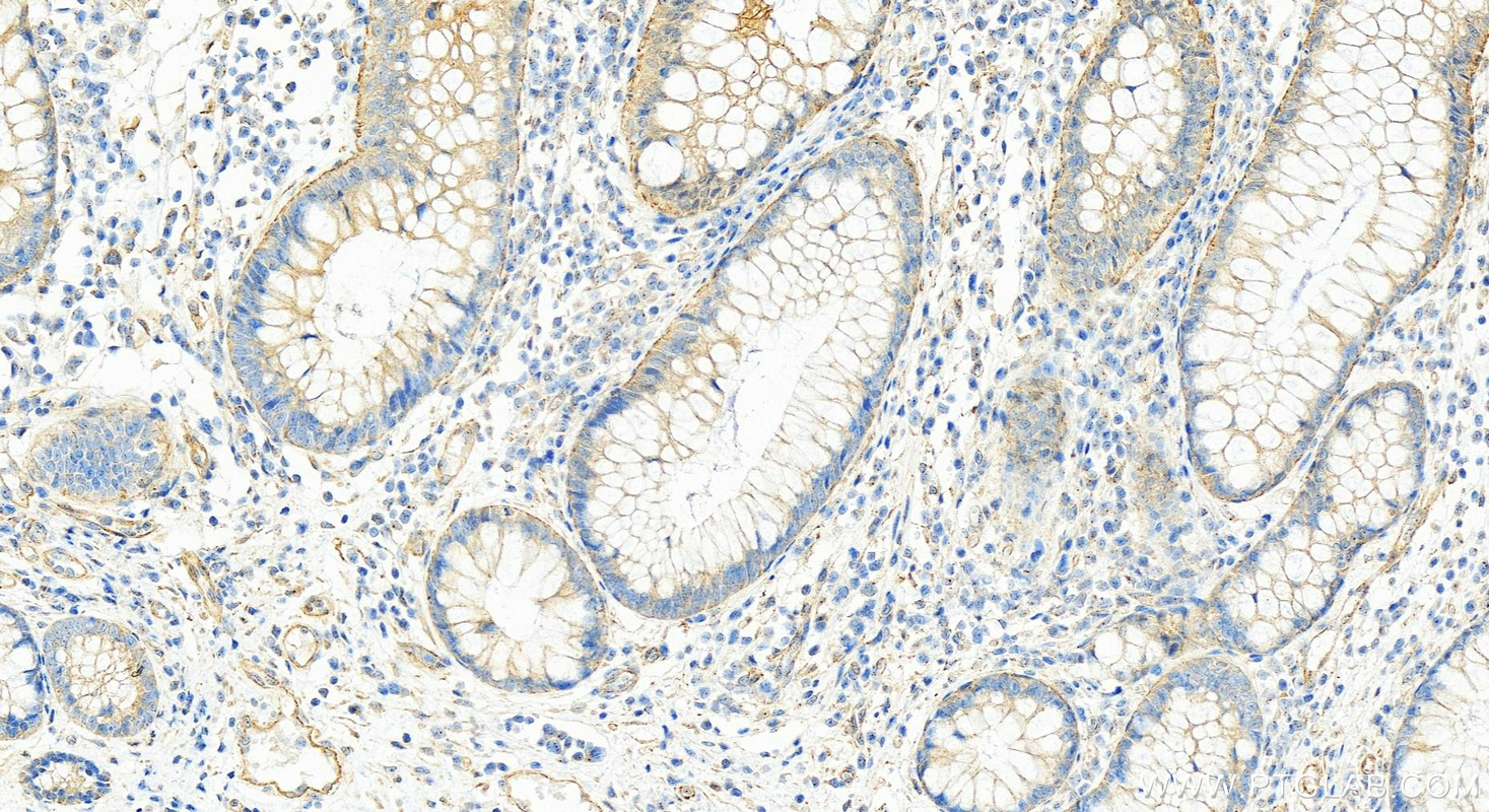 IHC staining of human colon cancer using 14875-1-AP