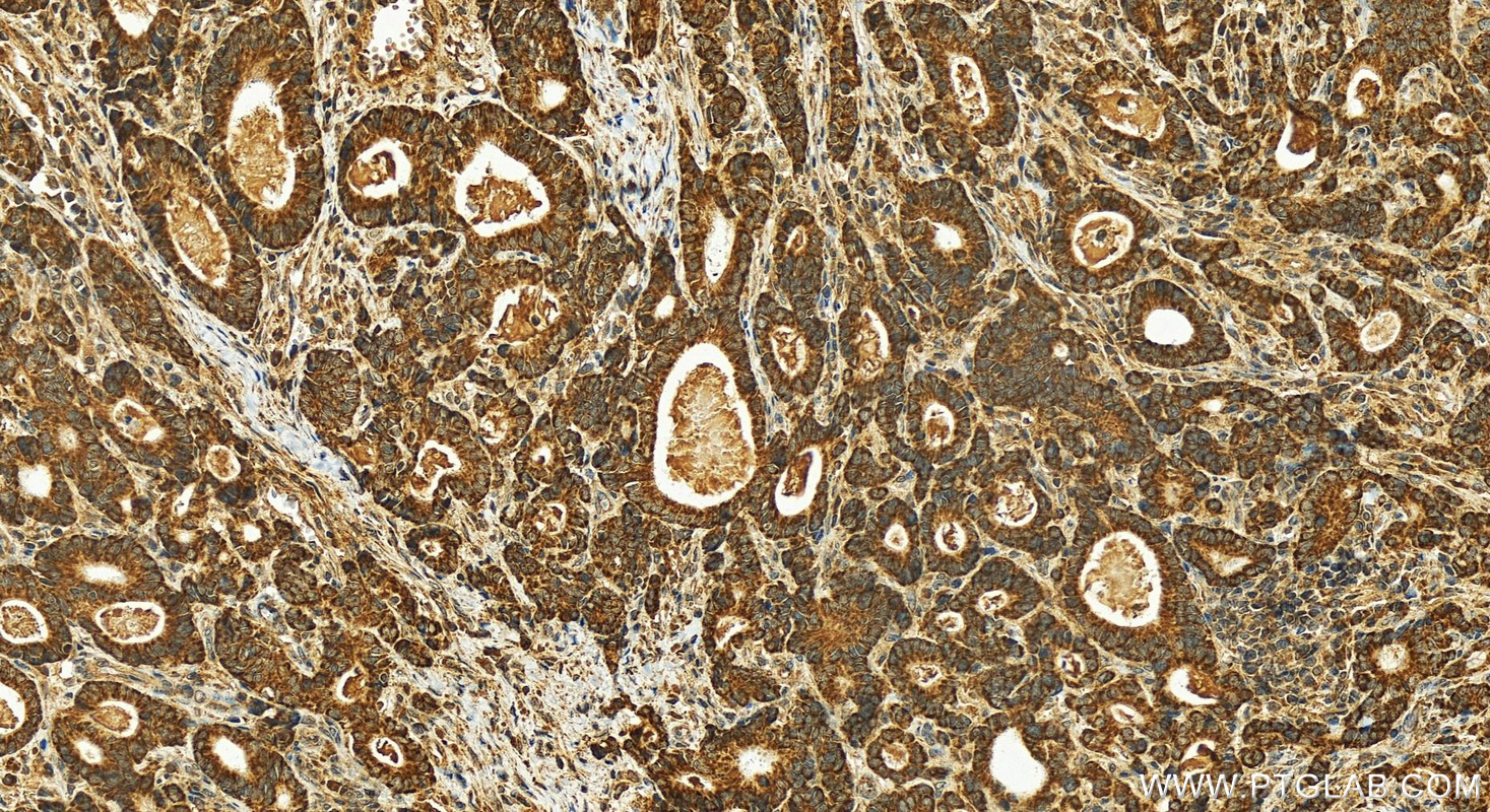 IHC staining of human stomach cancer using 12614-1-AP