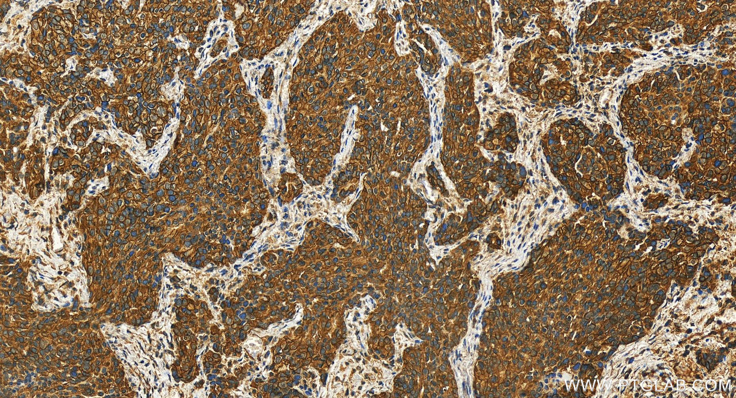 IHC staining of human ovary cancer using 27083-1-AP