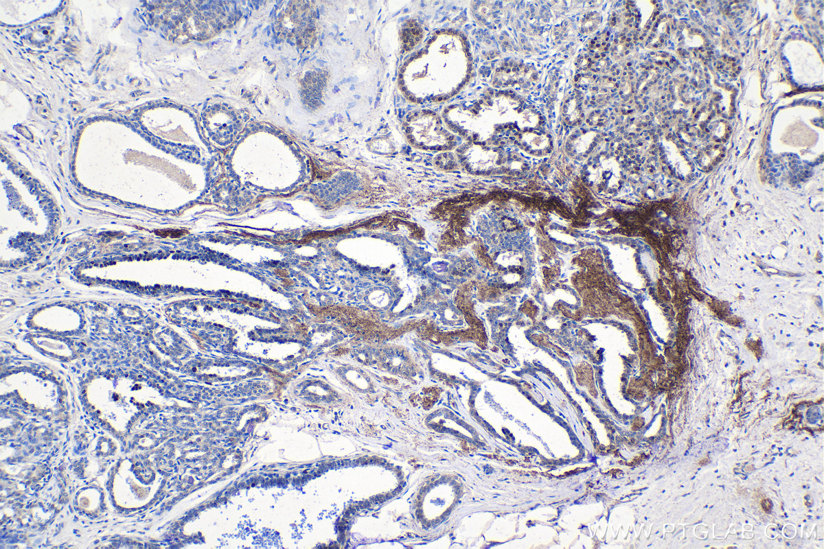 IHC staining of human breast cancer using 10407-1-AP