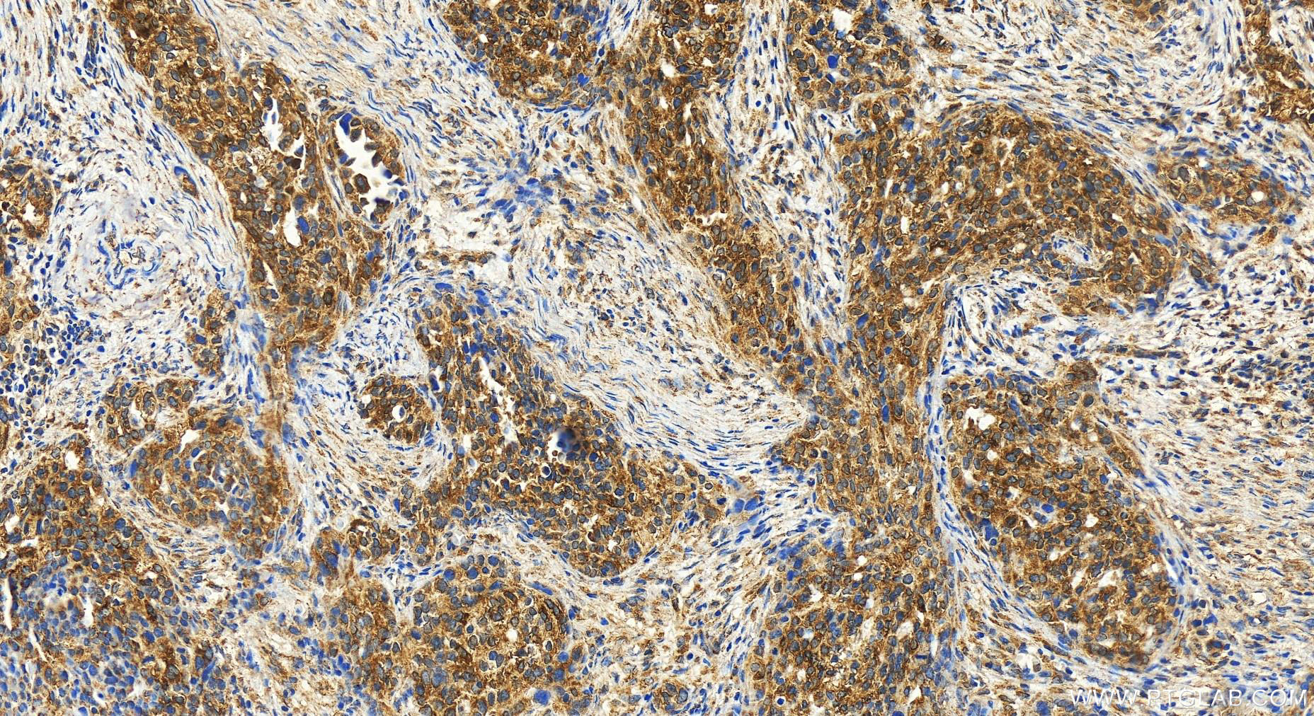 IHC staining of human ovary cancer using 14747-1-AP