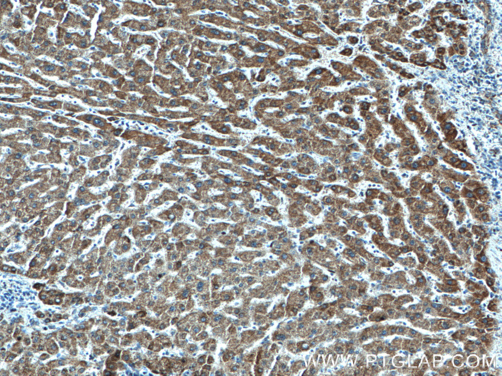 IHC staining of human liver cancer using 66588-1-Ig