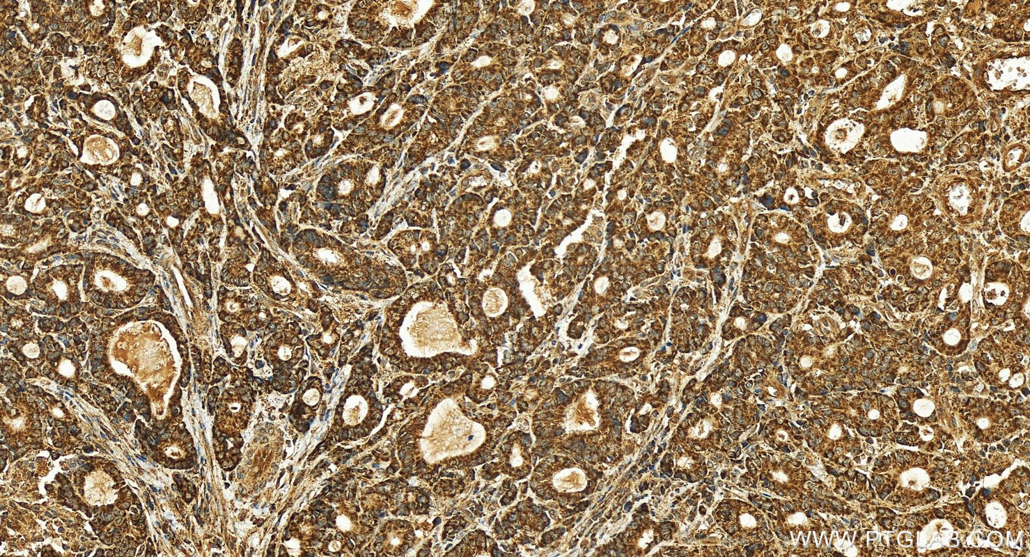 IHC staining of human stomach cancer using 26519-1-AP