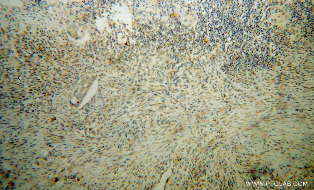 IHC staining of human colon cancer using 14753-1-AP