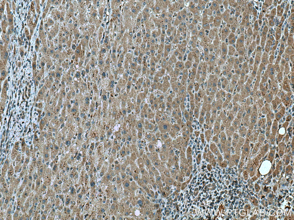 IHC staining of human liver cancer using 67379-1-Ig (same clone as 67379-1-PBS)