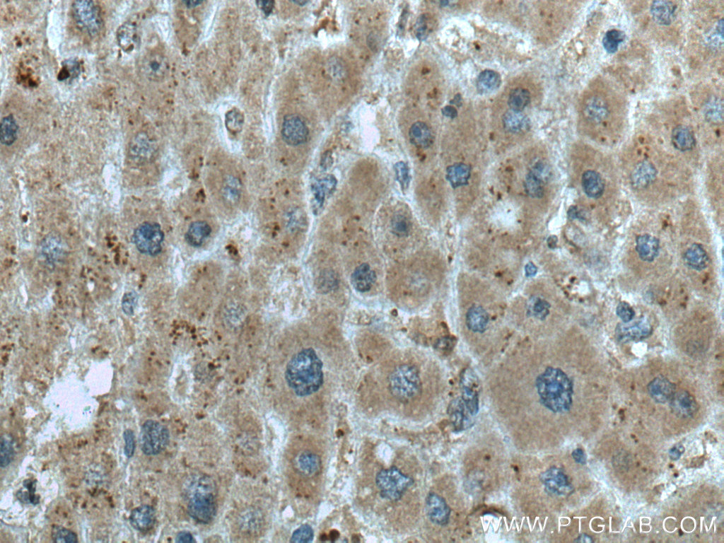 IHC staining of human liver cancer using 67379-1-Ig (same clone as 67379-1-PBS)