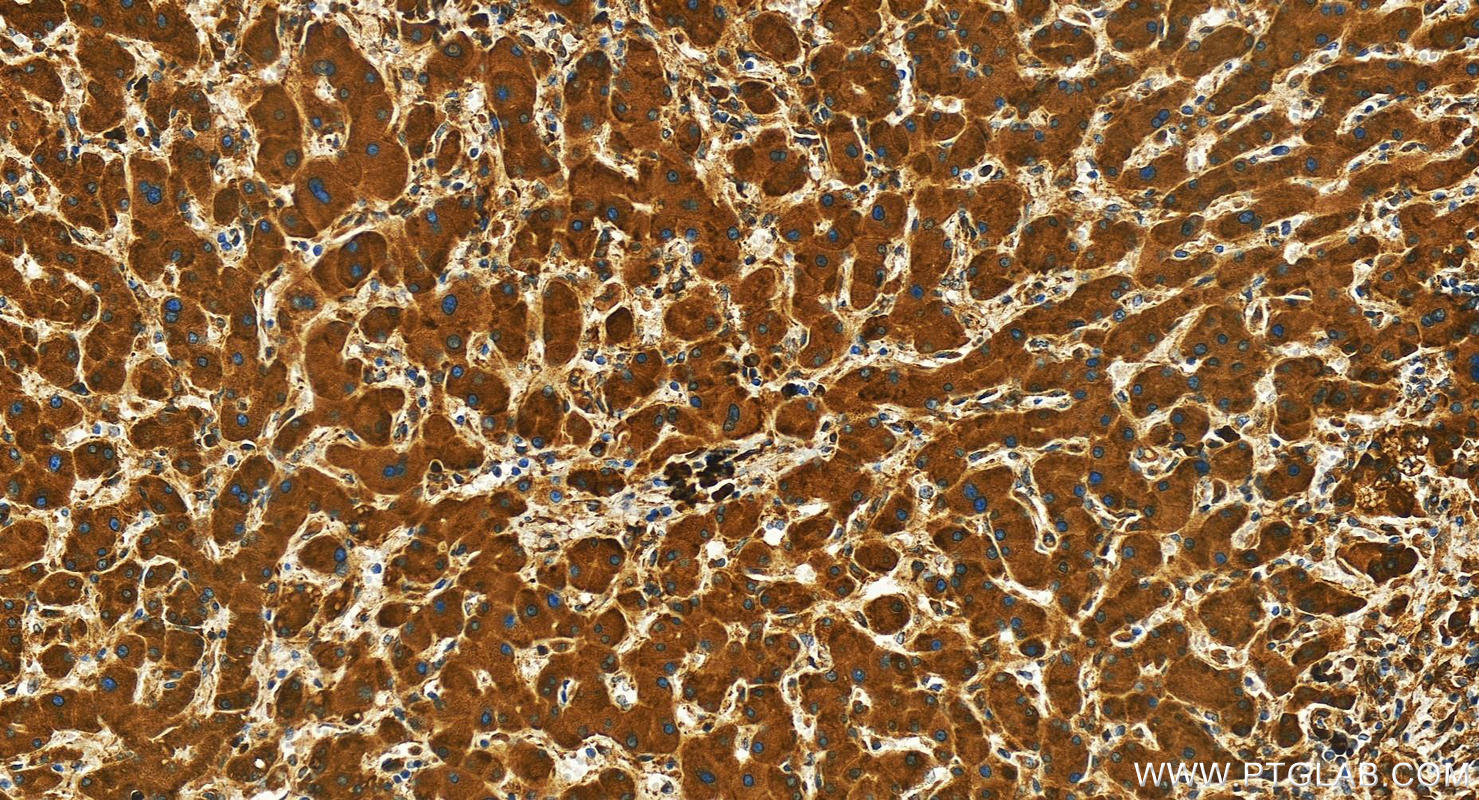 IHC staining of human intrahepatic cholangiocarcinoma using 29801-1-AP