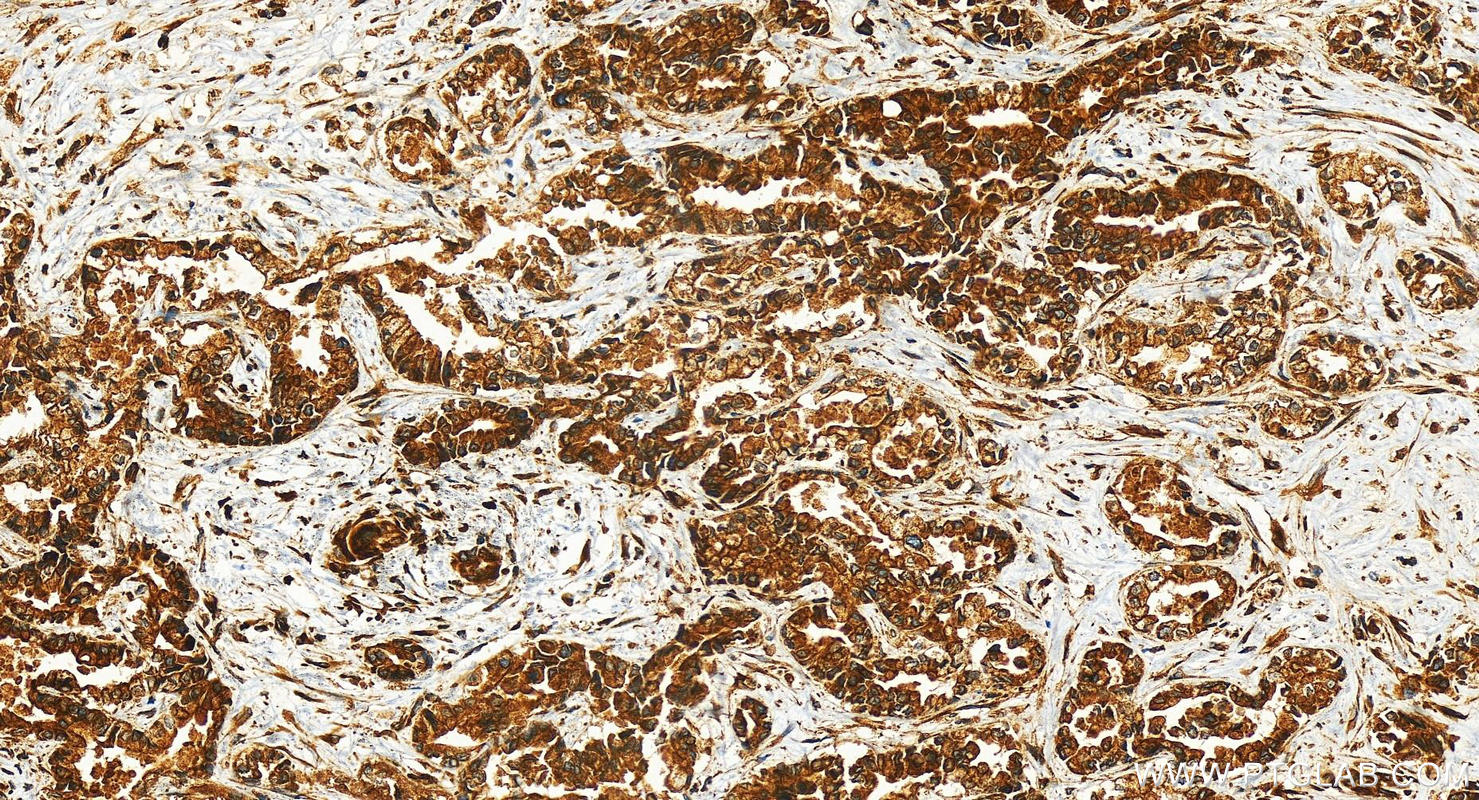 IHC staining of human intrahepatic cholangiocarcinoma using 29801-1-AP