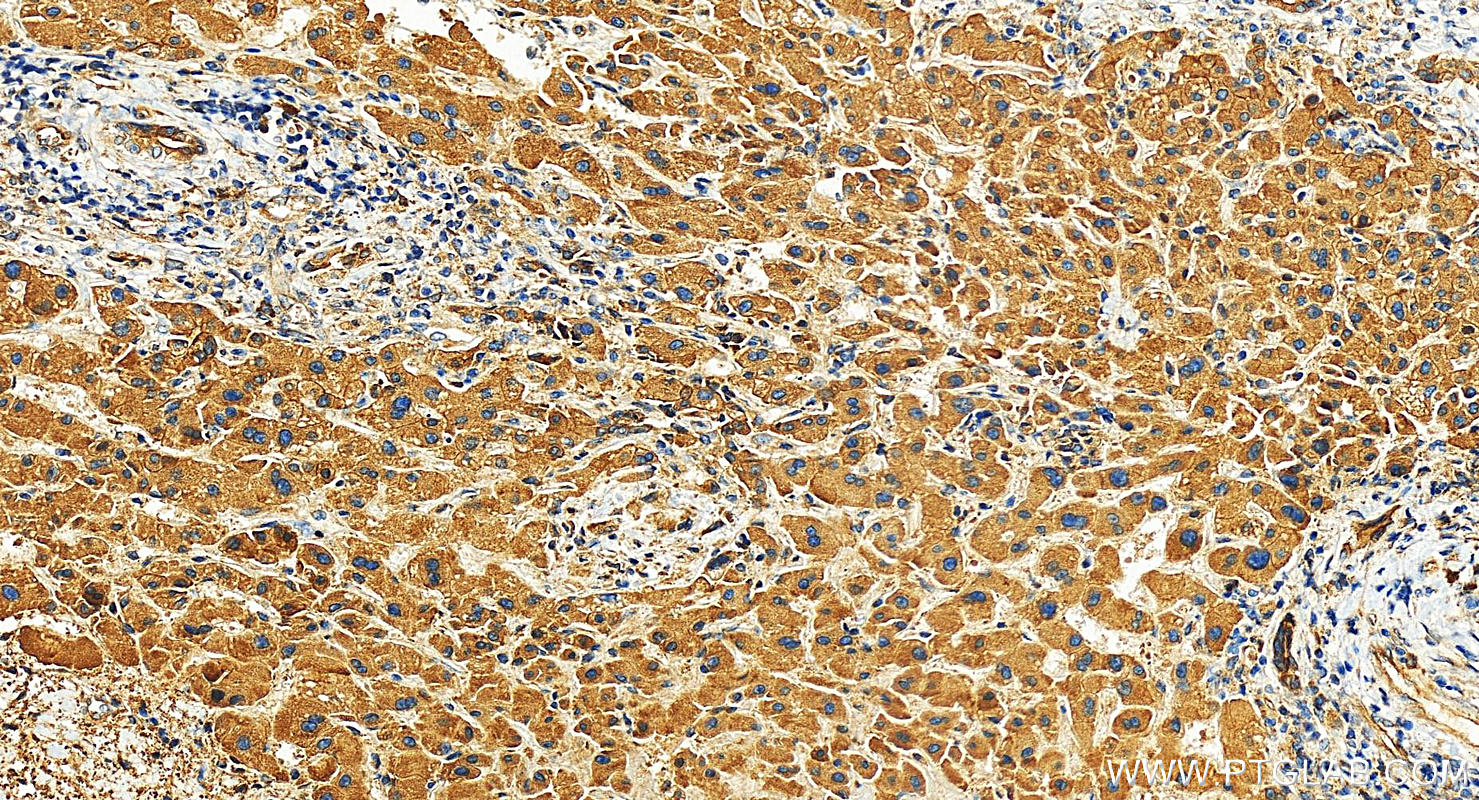 IHC staining of human intrahepatic cholangiocarcinoma using 15591-1-AP