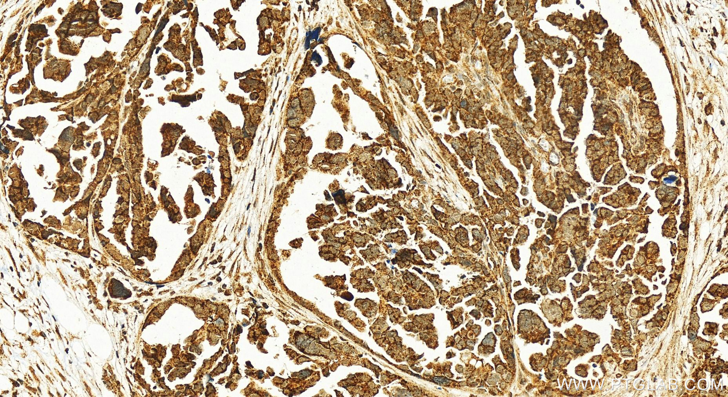 IHC staining of human ovary cancer using 25349-1-AP