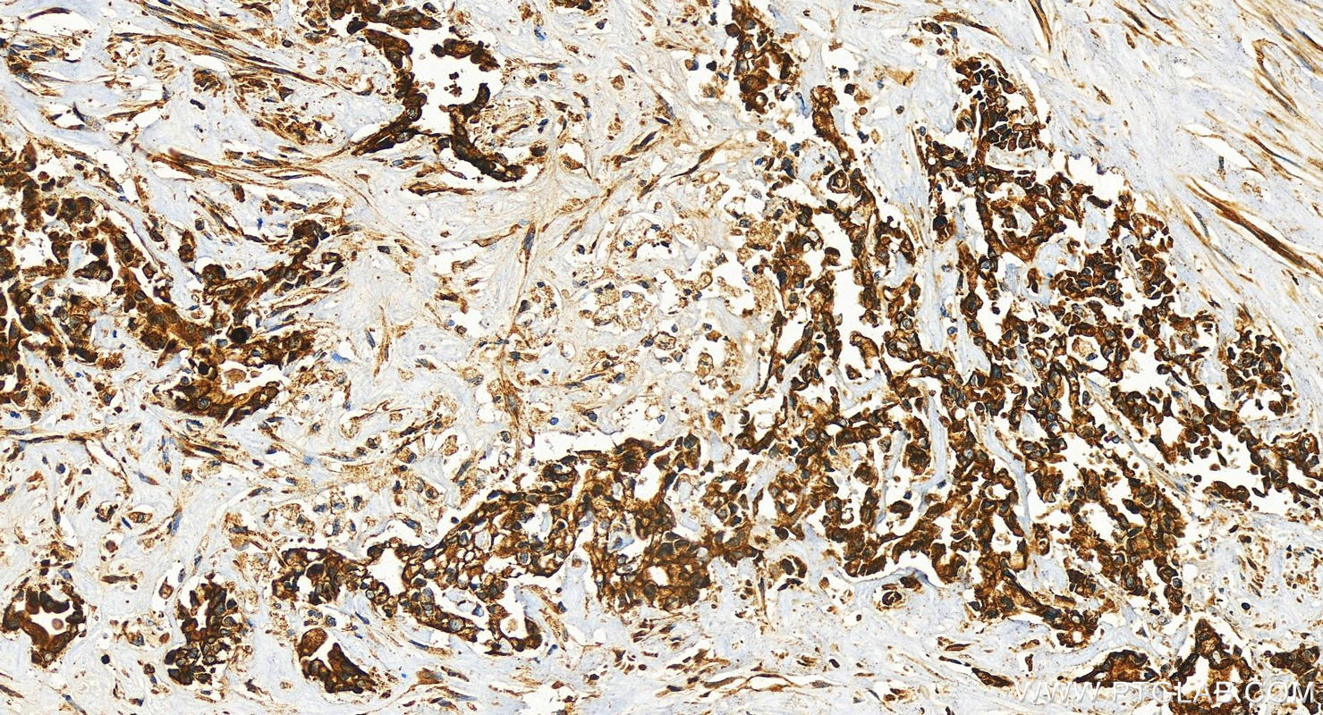 IHC staining of human intrahepatic cholangiocarcinoma using 83594-1-RR