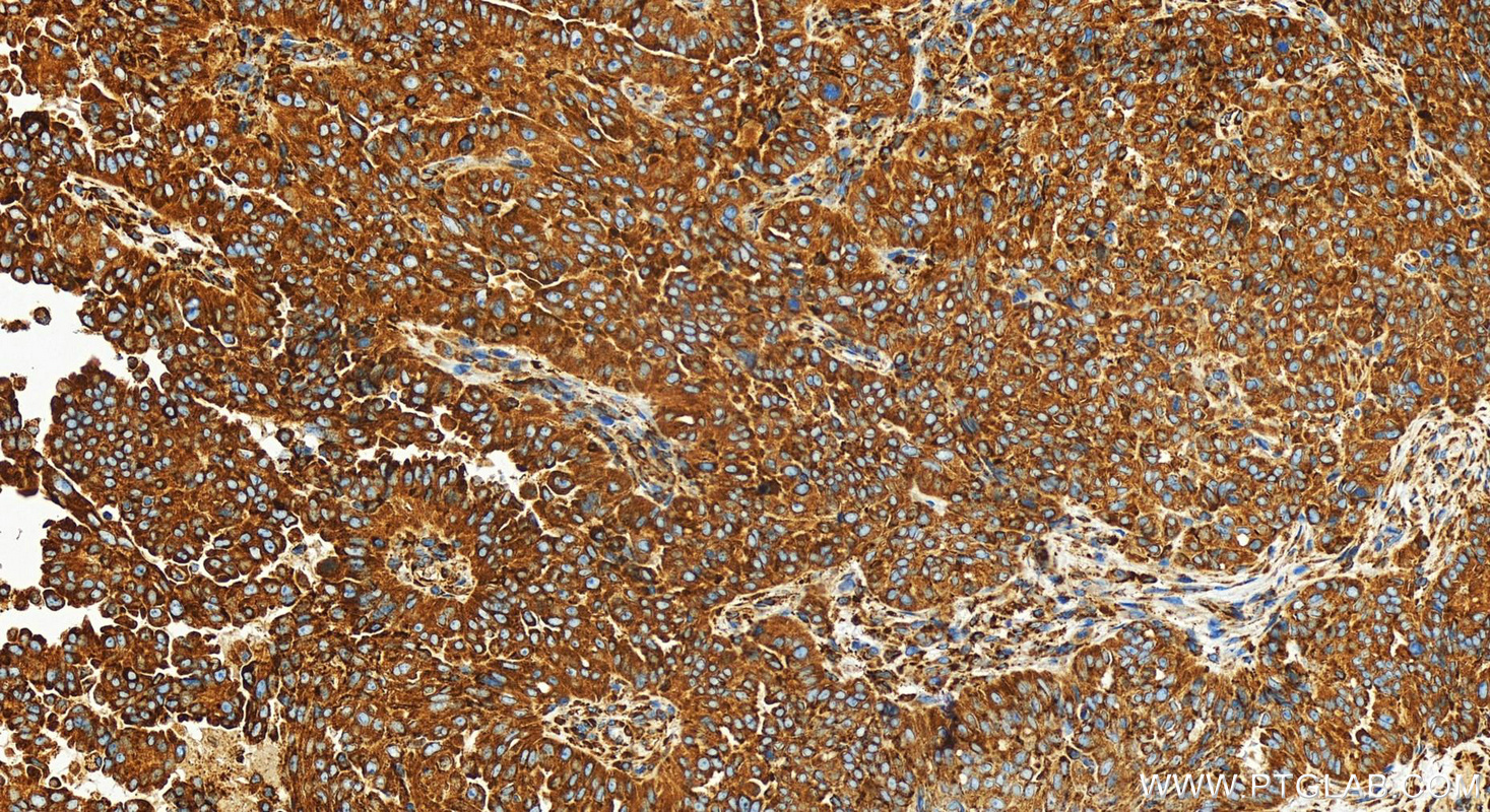 IHC staining of human ovarian  cancer using 83594-4-RR (same clone as 83594-4-PBS)