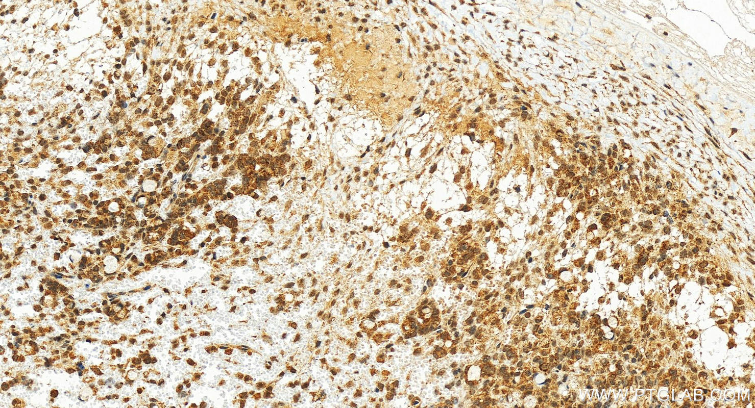 IHC staining of human ovary cancer using 17659-1-AP