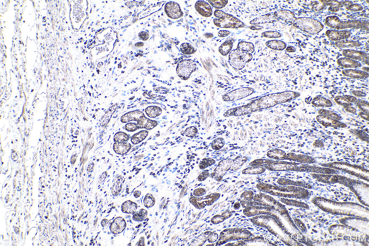 IHC staining of human stomach cancer using 13479-1-AP