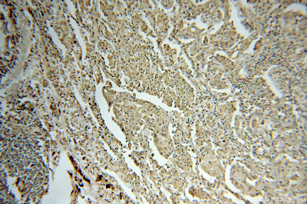 IHC staining of human lung cancer using 16635-1-AP