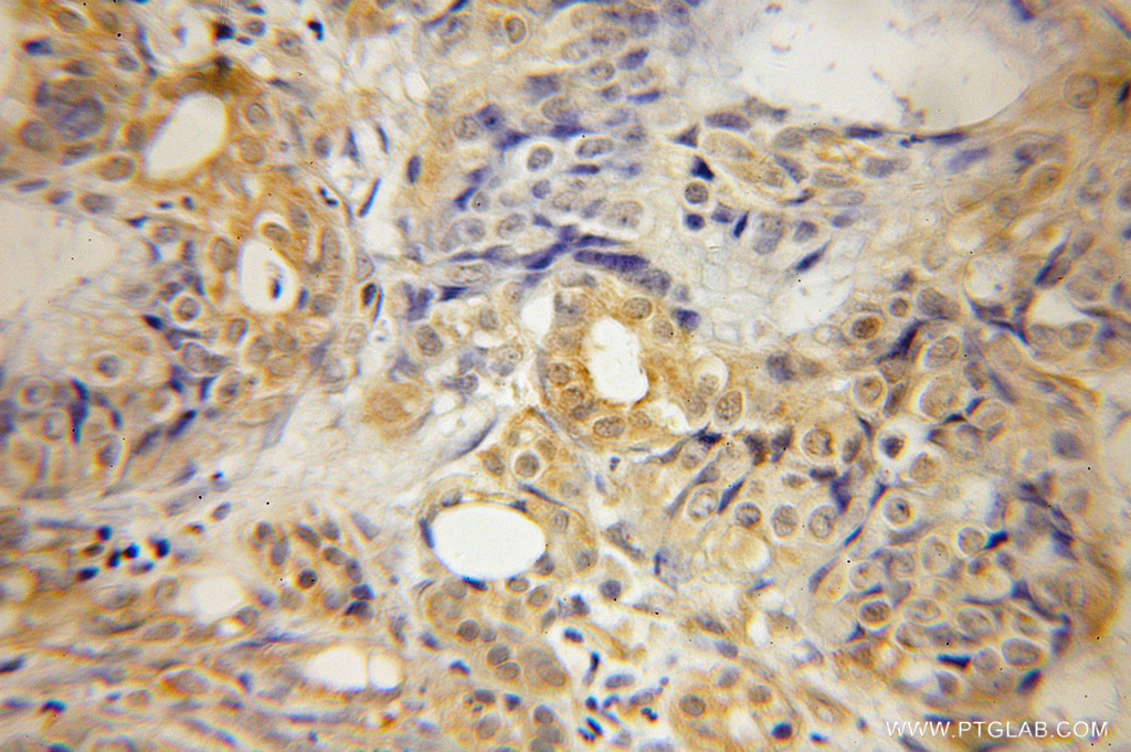 IHC staining of human pancreas cancer using 12420-1-AP