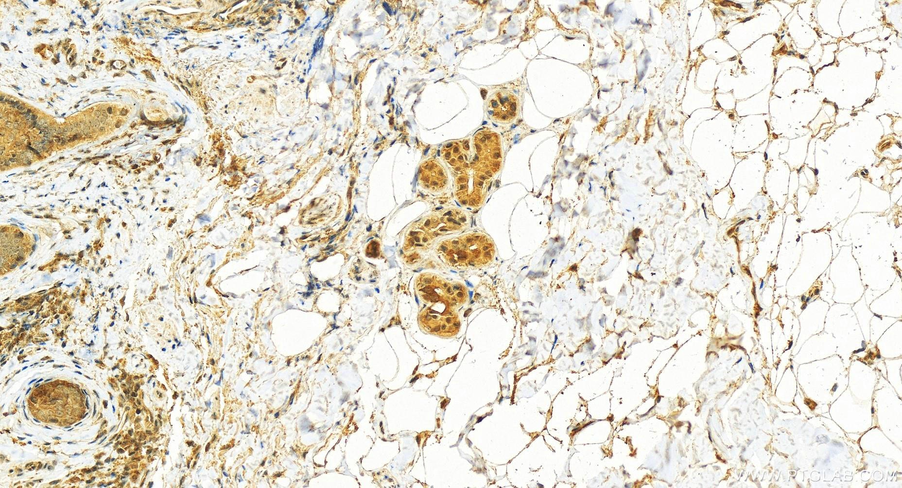 IHC staining of human skin cancer using 11691-1-AP