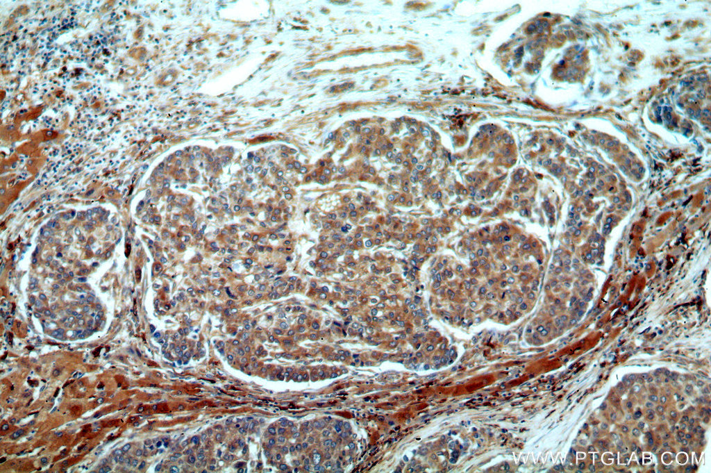 IHC staining of human liver cancer using 20265-1-AP