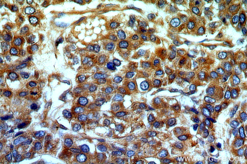 IHC staining of human liver cancer using 20265-1-AP