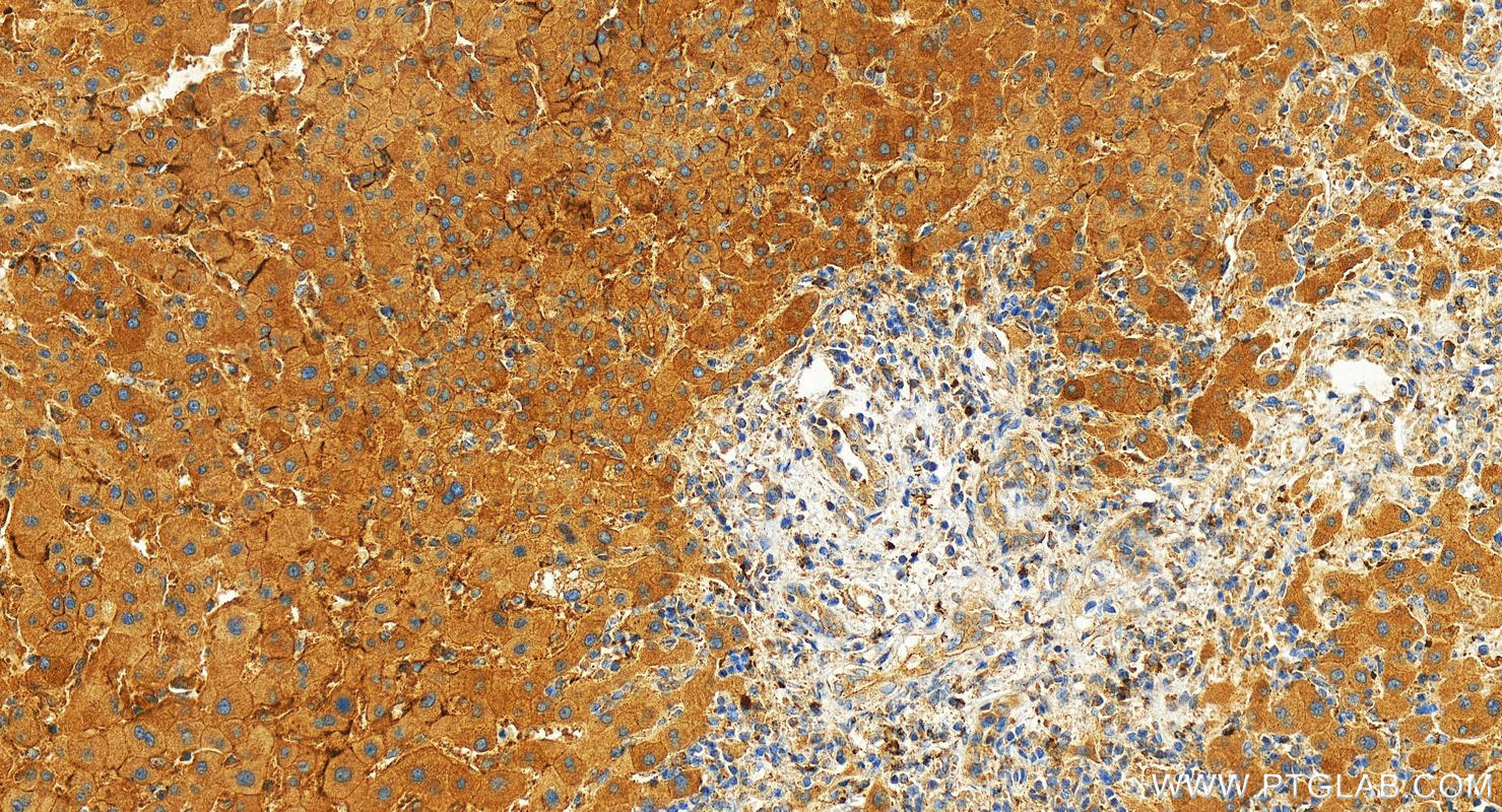 IHC staining of human intrahepatic cholangiocarcinoma using 26558-1-AP