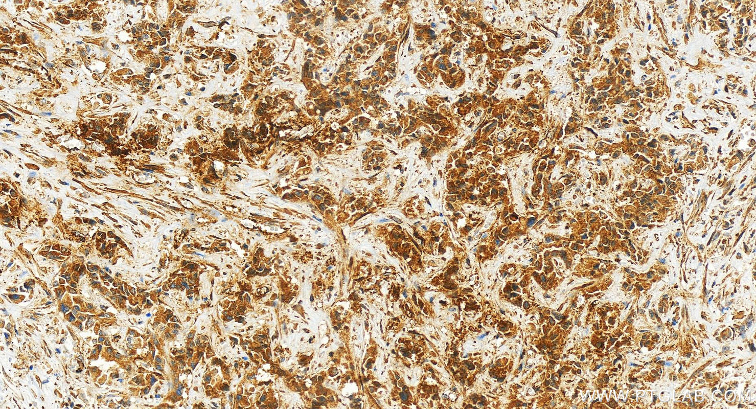 IHC staining of human intrahepatic cholangiocarcinoma using 26558-1-AP