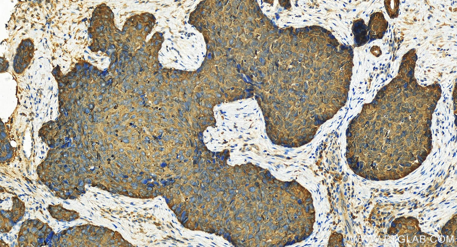 IHC staining of human bowen disease using 11722-1-AP