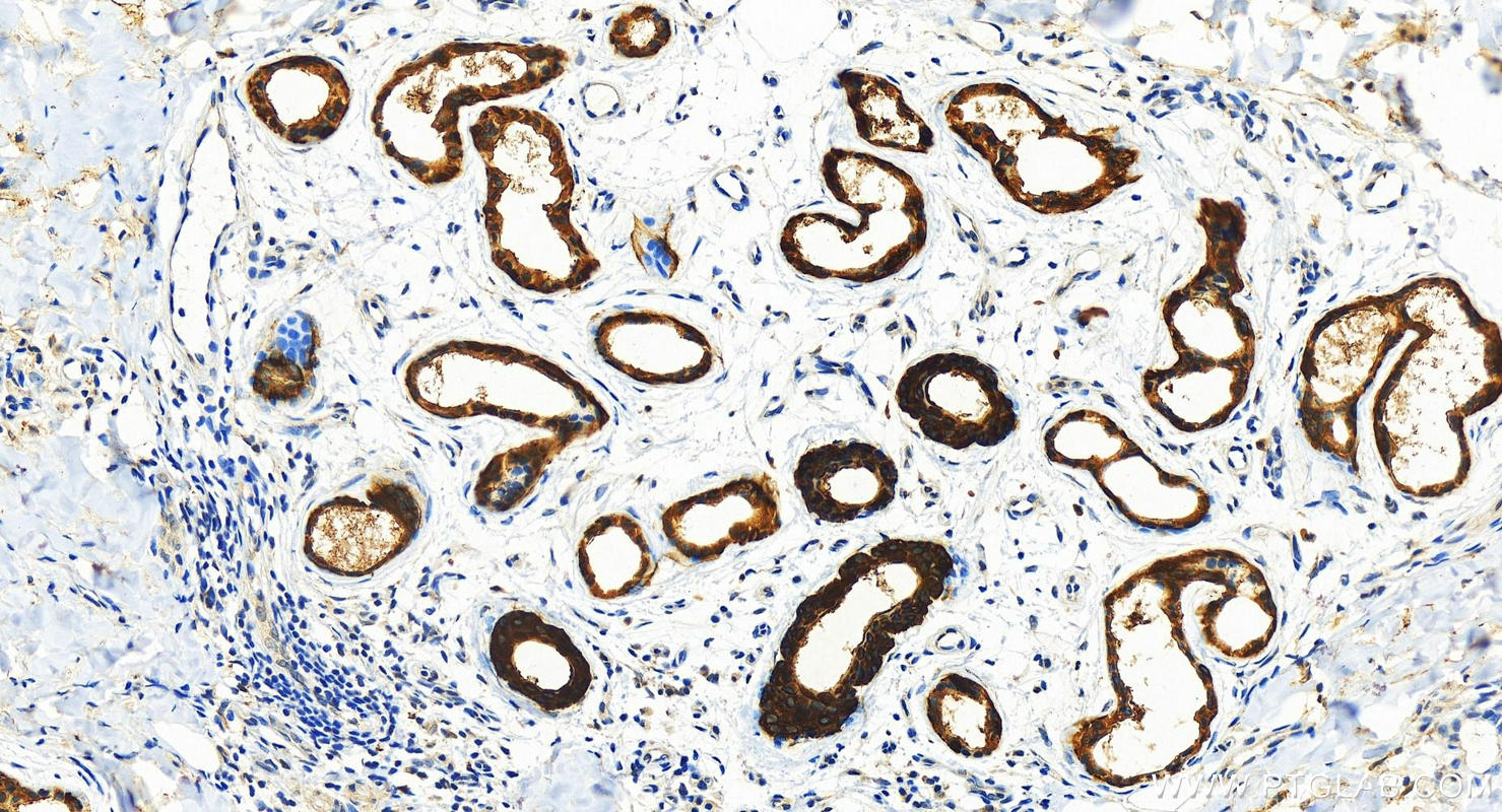 IHC staining of human bowen disease using 11722-1-AP