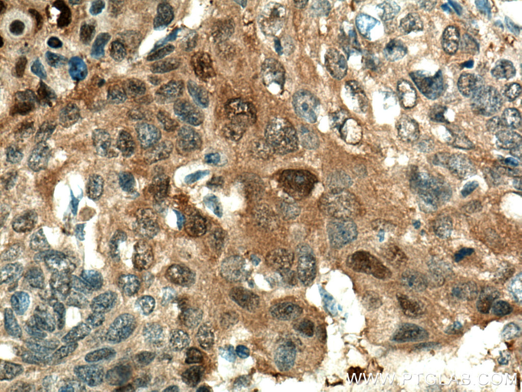 IHC staining of human oesophagus cancer using 67633-1-Ig (same clone as 67633-1-PBS)