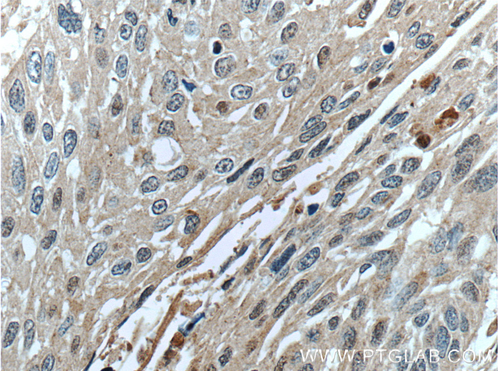 IHC staining of human oesophagus cancer using 13102-2-AP